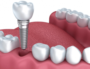 IMPLANT NHA KHOA?